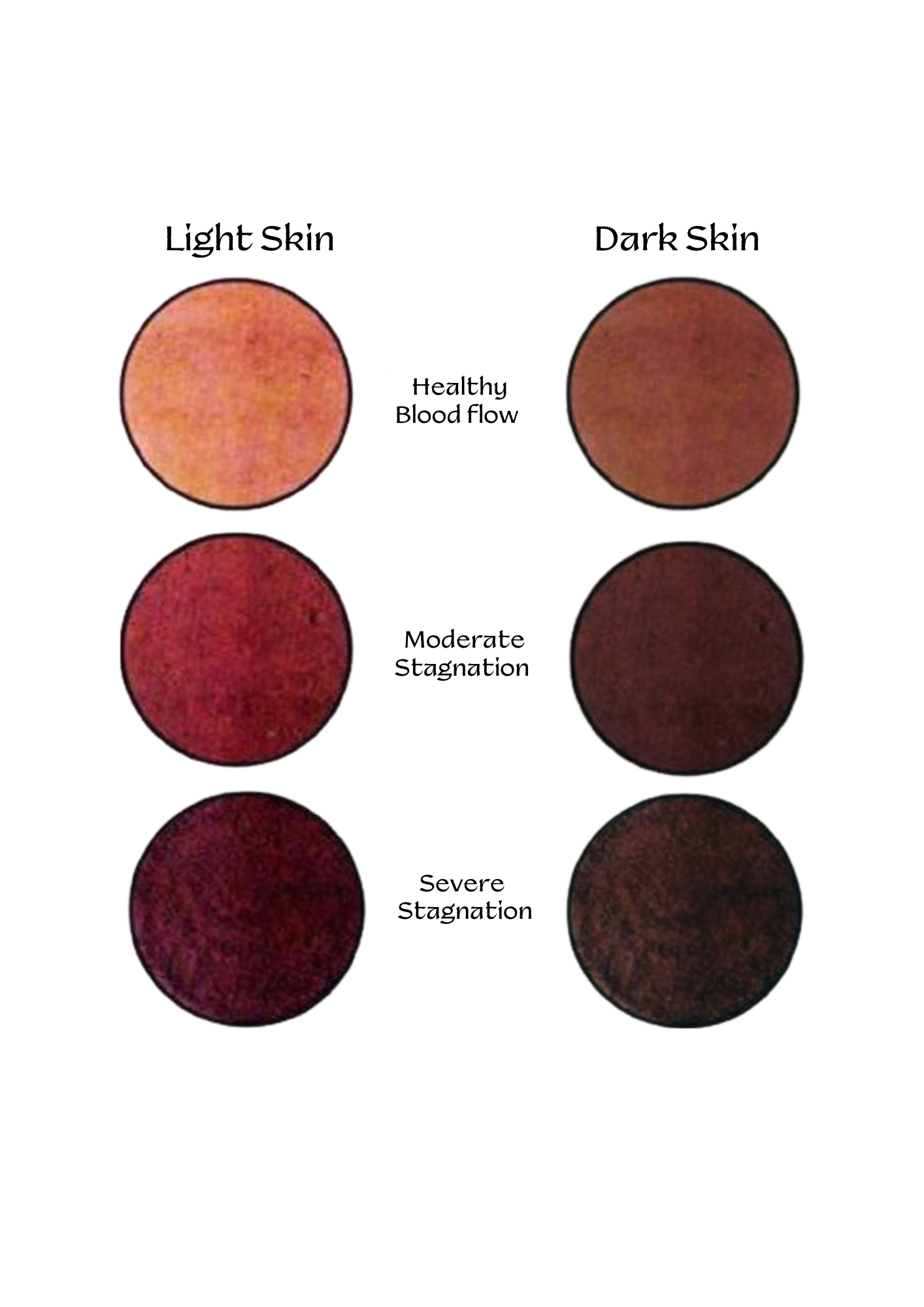Hijama blood stagnation color chart — from healthy blood flow to severe stagnation
